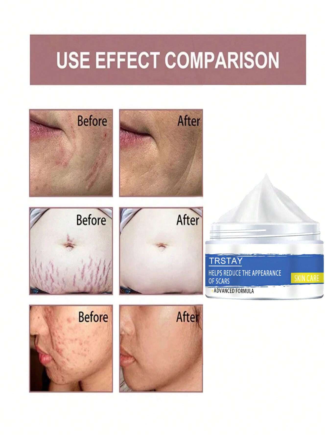 Skin Care Cream for Scars, Stretch Marks and Acne Skin, Scar Repair Cream for Scar Lightening and Skin Care Products for Skin Refreshment - Image 3