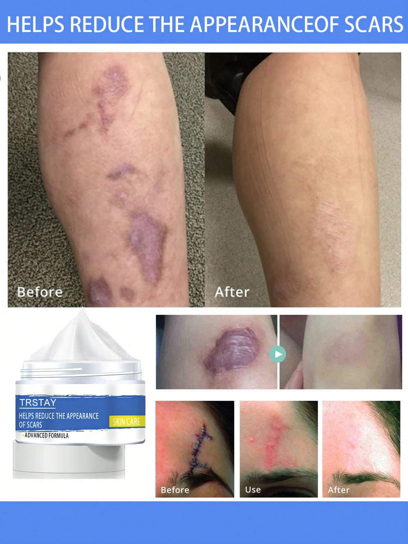 Skin Care Cream for Scars, Stretch Marks and Acne Skin, Scar Repair Cream for Scar Lightening and Skin Care Products for Skin Refreshment